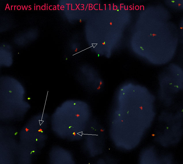 Image 10 - TLX3 BCL11b fusion